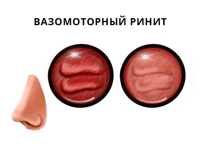 Хроническое воспалительное заболевание слизистой носа